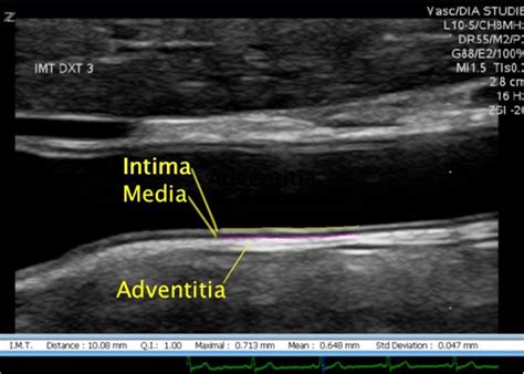 carotid intima media thickness measurement|intimal thickening on carotid ultrasound.